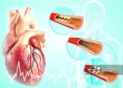 中青年患心梗比例上升 专家：保持健康生活方式 普及救急技能 