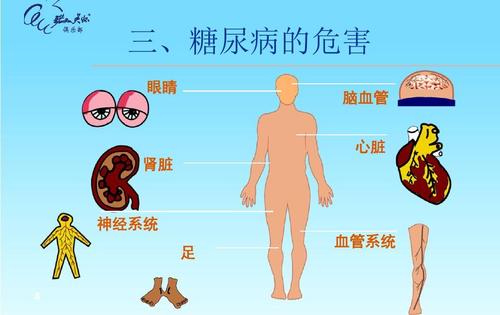 糖尿病真的是“富贵病”吗？ 专家指出大家对对糖尿病的误解